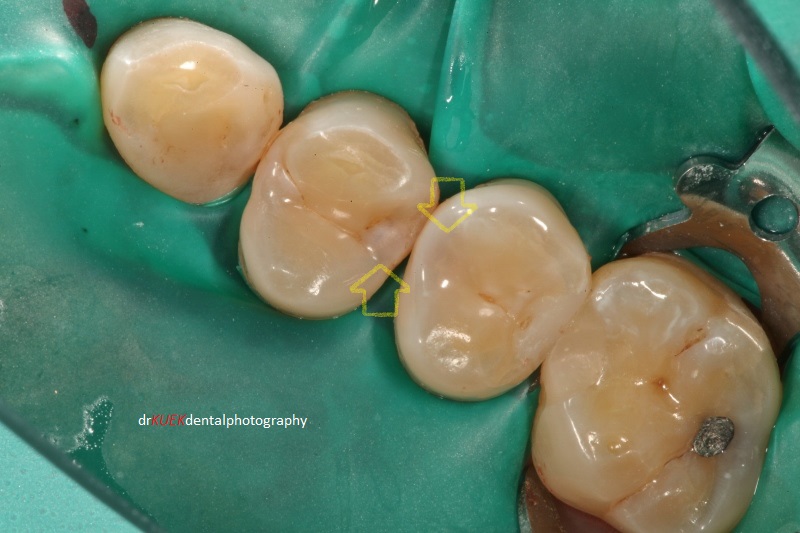 Decayed cavities are hidden here (yellow arrows). The areas are slightly darker in colour.
