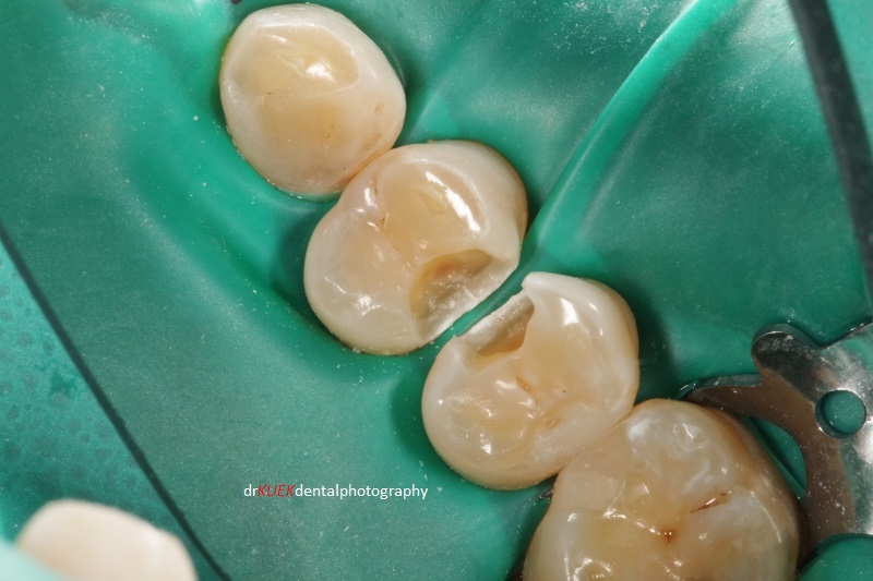 Decayed areas cleaned. Hard and sound enamel left in place, even though appeared whitish. Often 'chasing' demineralized enamel is not necessary as it will deepen the cavity. However, I always advise periodic radiograph reviews to check these areas and of course, Mr Smith has to maintain good oral hygiene.