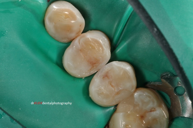 Composite resin sculpted to follow the natural teeth shape. Tints used to highlight and blend the fillings with the teeth. Contact between these teeth were built using Triodent V3-ring and their matrix system. Note: the other 2 fillings between the lower and second lower teeth in this photograph were done 7.5 years ago by, yours truly. At that time, I had less choices of composite resin shades and no access to tints. One shade of composite resin was used (Esthet X, not the HD version) with the first Triodent V-ring system. Aesthetically is acceptable and functionally is still 100%. The method of placing these composite resin fillings have not changed very much over the years of my practice. Hence, I believe with proper and careful technique, composite resin fillings can be long lasting.