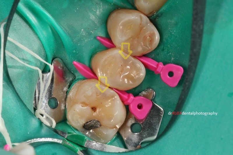 Teeth are isolated =with rubber dam. Decayed teeth were below these areas (yellow arrows). Triodent wave-wedges (pink) were used to pre-wedge these teeth, important for good contacts in the final results.