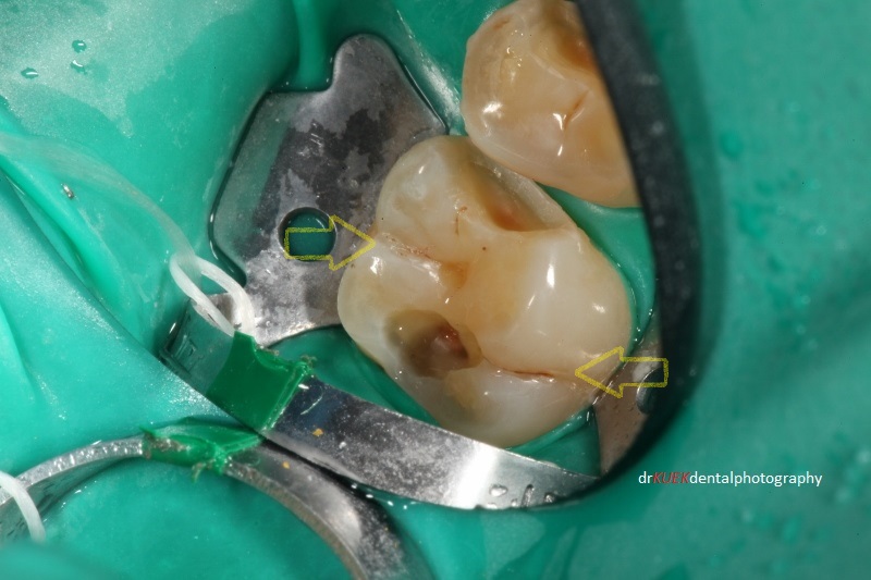 There was decay under the existing amalgam filling. Natural grooves in this molar tooth were also cleaned even though they were not decayed. I routinely seal these grooves if part of the tooth being worked on needed a filling (yellow arrows).