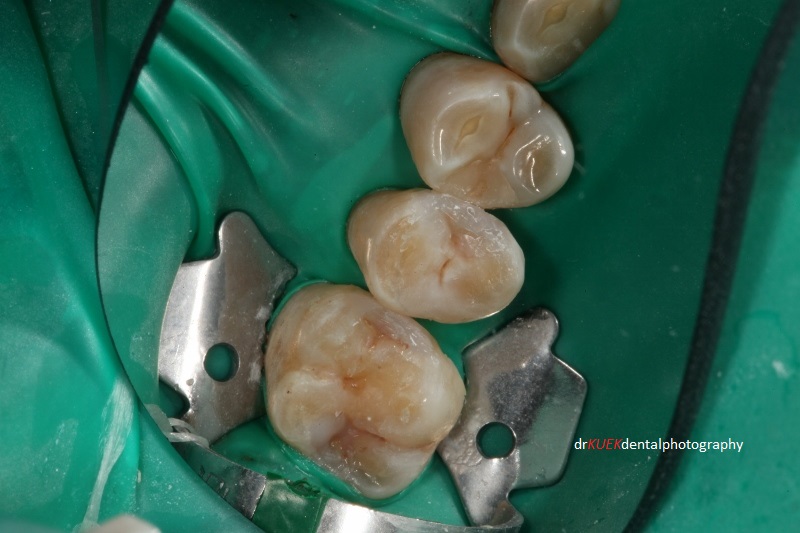 Shades of composite resin materials were chosen and tints were used to create the fillings, aimed to blend the fillings with the natural teeth.