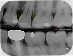 Dark shadows can be detected, though challenging to the untrained eye. Decayed teeth shown (Yellow arrows) on radiograph.